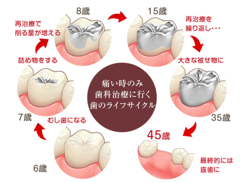 むし歯のサイクル