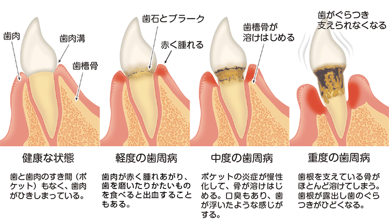 歯周病の進行